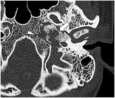 Case Report: Diagnosis of Petrous Apex IgG4-Related Disease by Middle Cranial Fossa Craniotomy and Temporal Bone Biopsy